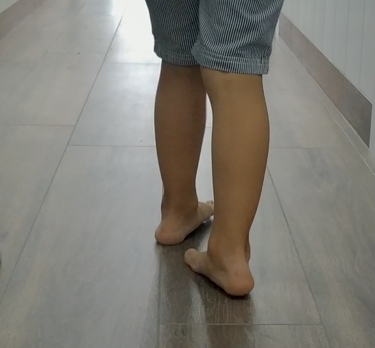 ¡ Mi hijo anda con los pies hacia dentro!