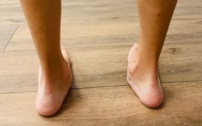 ¿Fascitis, pie plano y dolor de tobillo?