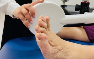 ¿En qué consiste el tratamiento CMP para mi pie?