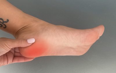 Dolor de talón: cuándo el problema está en el nervio