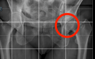 La cadera: origen oculto del dolor de talón.