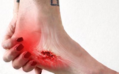 Fascitis , fasciosis o rotura ?