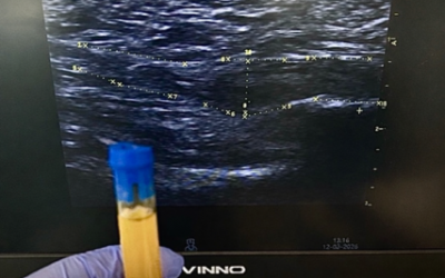 Infiltraciones en el dolor de talón: ¿cuándo, cómo y por qué?