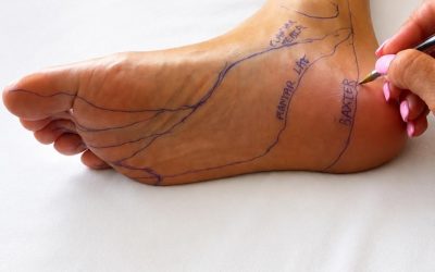 Fascitis plantar ? Baxter ?